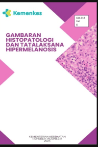 Image of Ebook : Gambaran Hispatologi dan Tatalaksana Hipermelanosis
